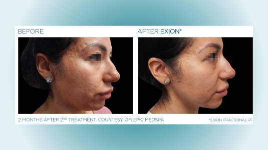 before and after microneedling 2