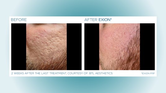 before-and-after-microneedling-3